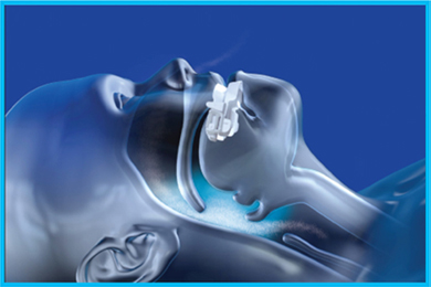 X-ray graphic of jaw movement when snoring