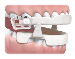Image of the SleepRight Snore Aid worn on a set of teeth