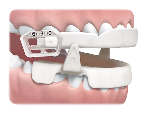 Image of the SleepRight Snore Aid worn on a set of teeth